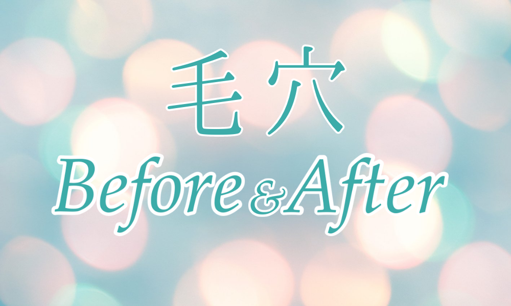 毛穴ビフォーアフター【インスタ投稿】